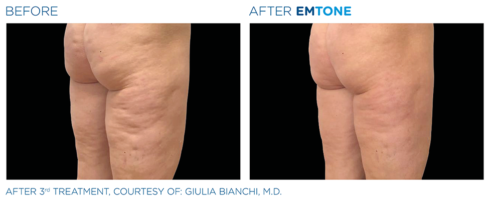Emtone Cellulite Service Lakeland Florida