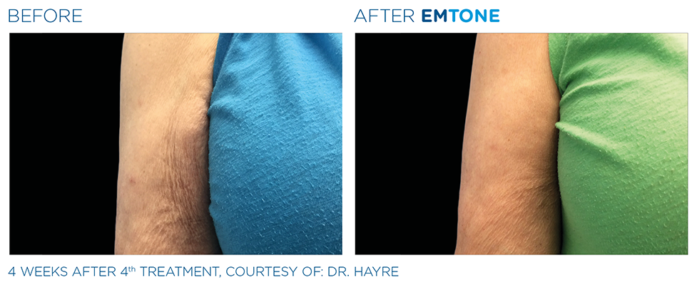 Emtone Cellulite Services Lakeland Florida